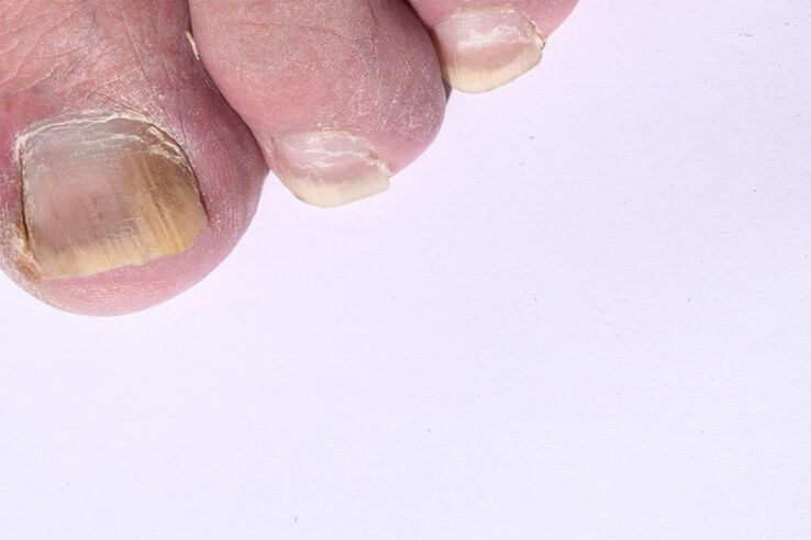 la fase iniziale della micosi delle unghie dei piedi