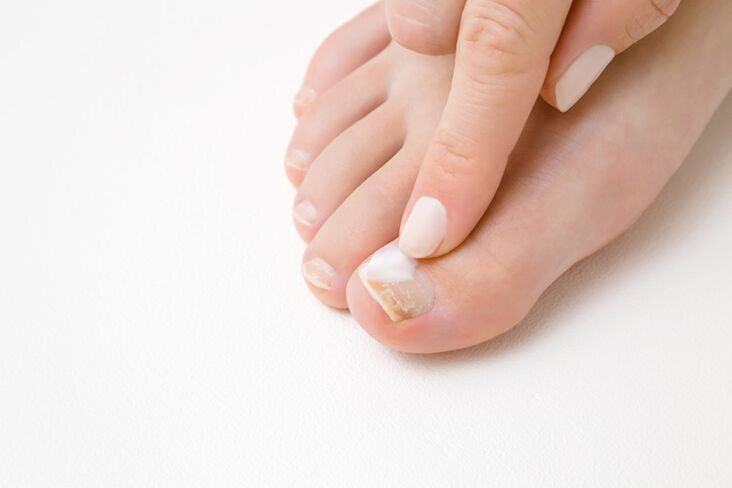 trattamento delle dita dei piedi con unguento per funghi