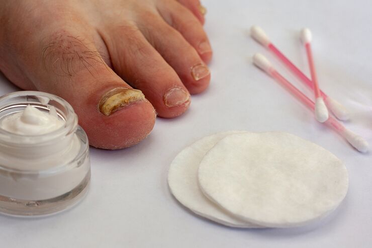 trattamento fungo dei piedi con crema di funghi