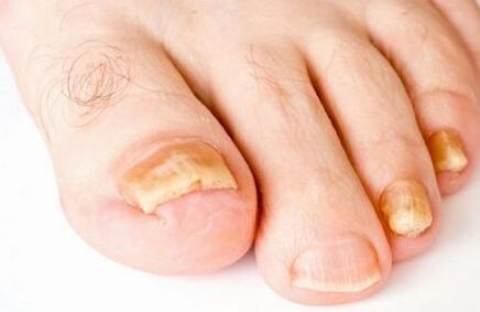 ingiallimento delle unghie dei piedi con funghi