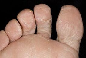 sintomi di funghi sulla pelle dei piedi