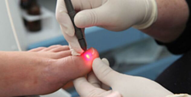 Laserterapia per il fungo dell'unghia del piede