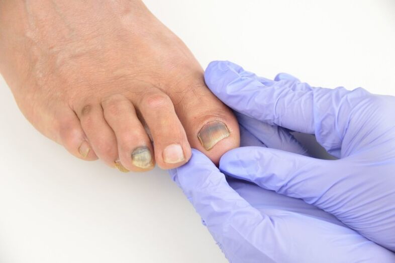Esame medico delle unghie dei piedi colpite da un fungo