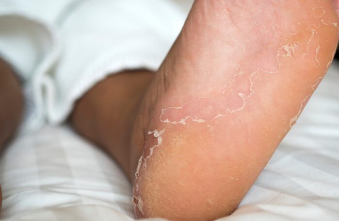 infezioni ai piedi con funghi alle unghie