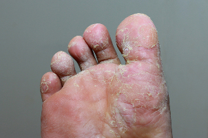 Pesante fase di micosi della pelle delle dita dei piedi